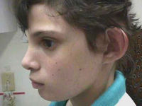 Пластика ушей