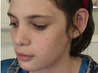 Пластика ушей